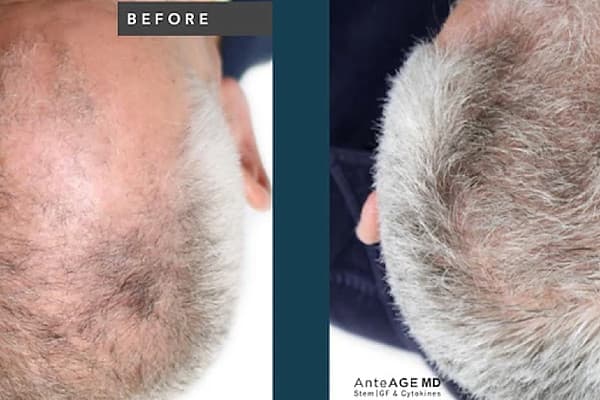 Hair Restoration